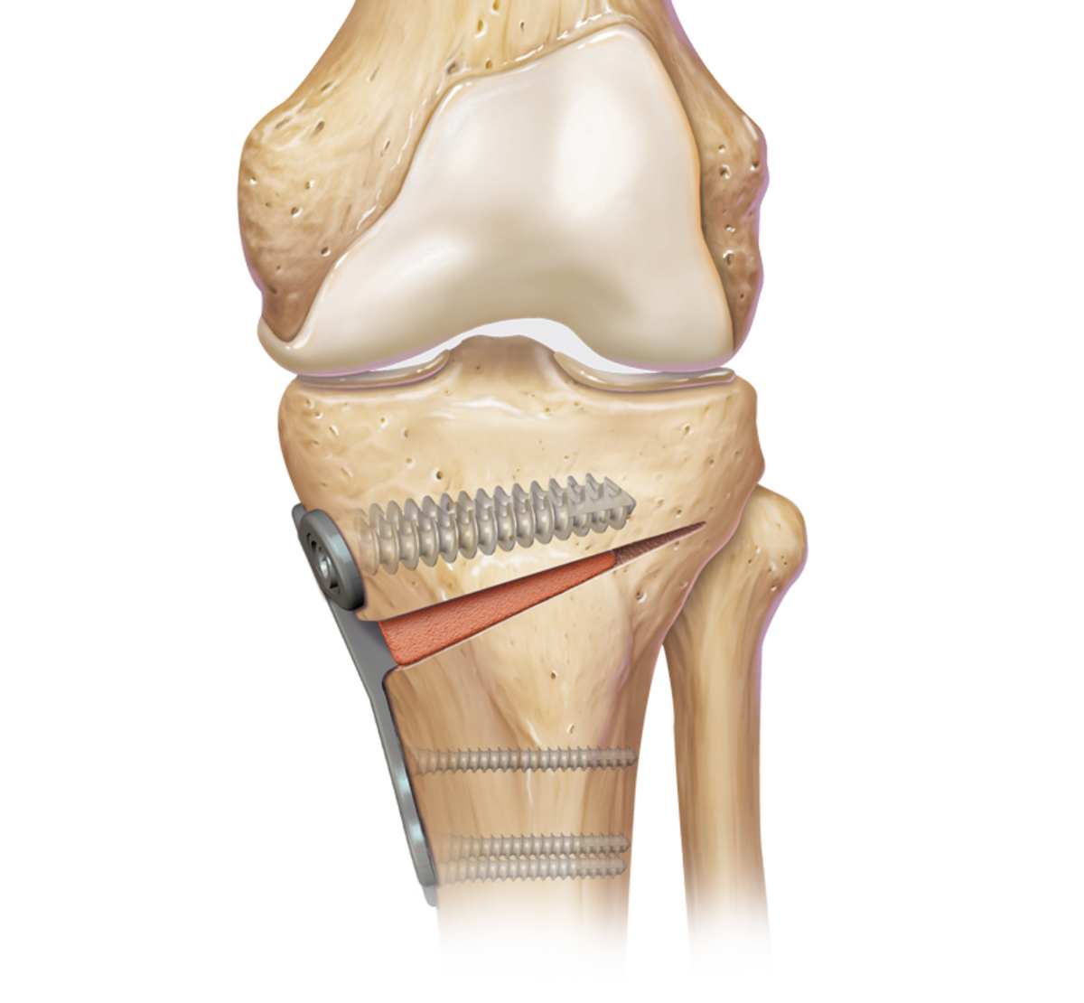 Arthrex - Tibial Opening Wedge